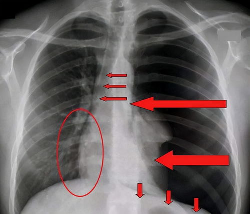 为什么高瘦男性容易得气胸