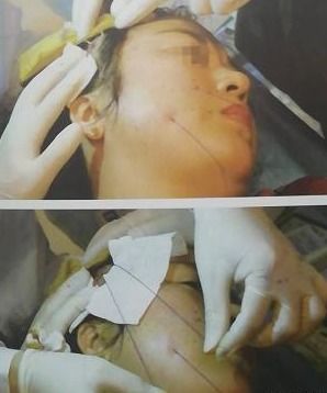 女子线雕手术三年后脸上钻出一根线