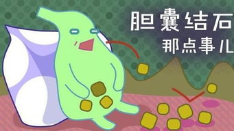 胆结石病人游戏攻略