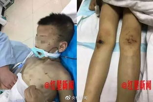 男童遭虐待致轻伤二级 生父被刑拘 男童遭虐待致轻伤二级 生父被刑拘