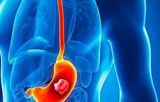 28岁胃癌前病变女生的忠告 28岁胃癌前病变女生的忠告