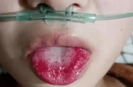 女孩吃糖葫芦粘掉近3万元种植牙