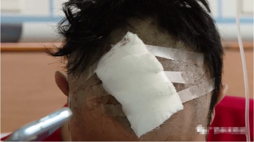 男子用3D打印帮舅舅补上断指